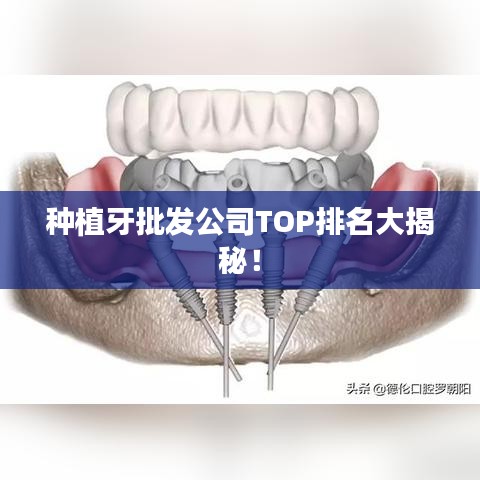 种植牙批发公司TOP排名大揭秘！